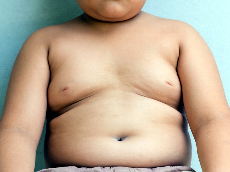 Obesità: un bambino su tre in sovrappeso strana coincidenza con il cancro!